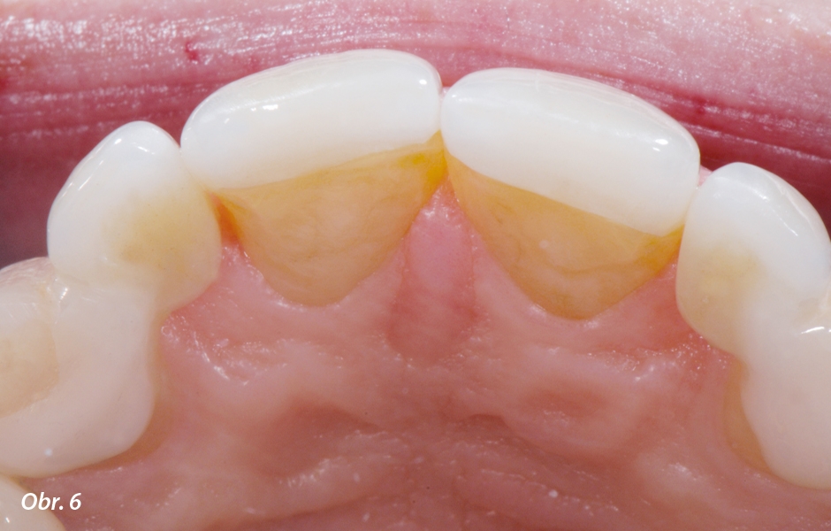 The Zirconia Resin Bonded Bridge (RBB)