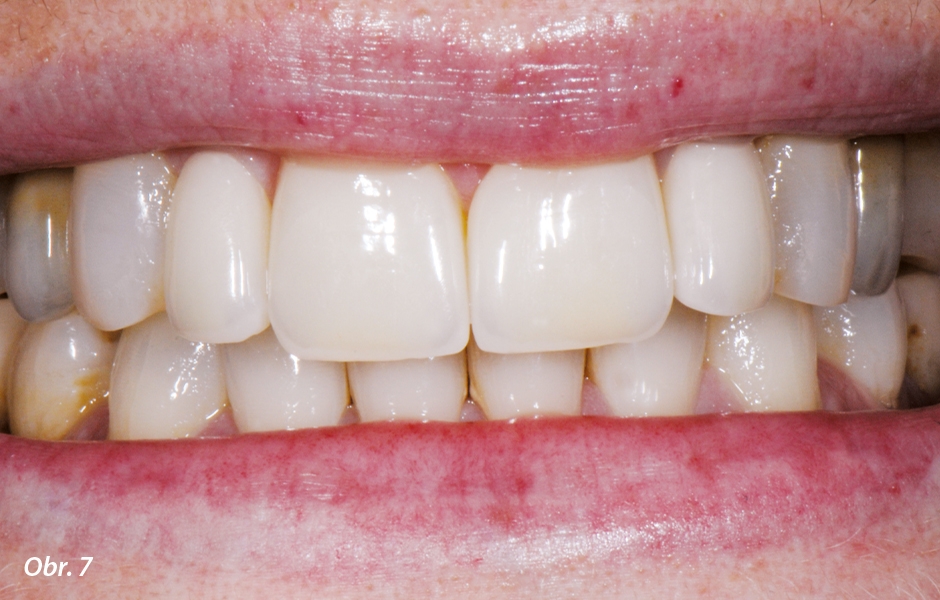 The Zirconia Resin Bonded Bridge (RBB)