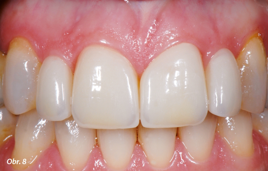 The Zirconia Resin Bonded Bridge (RBB)