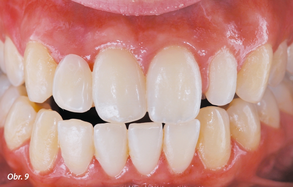 The Zirconia Resin Bonded Bridge (RBB)