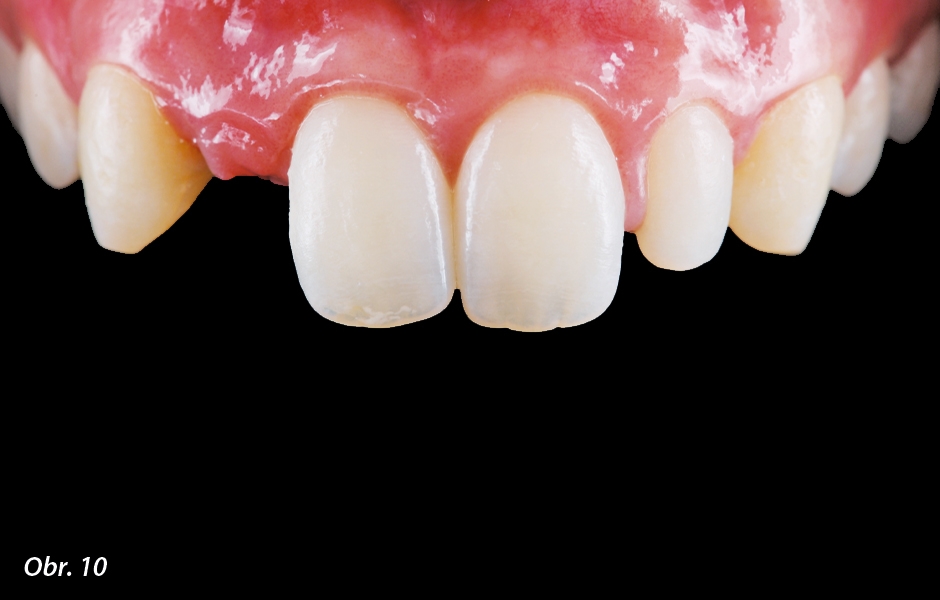 The Zirconia Resin Bonded Bridge (RBB)