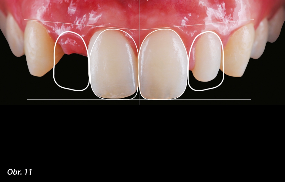 The Zirconia Resin Bonded Bridge (RBB)