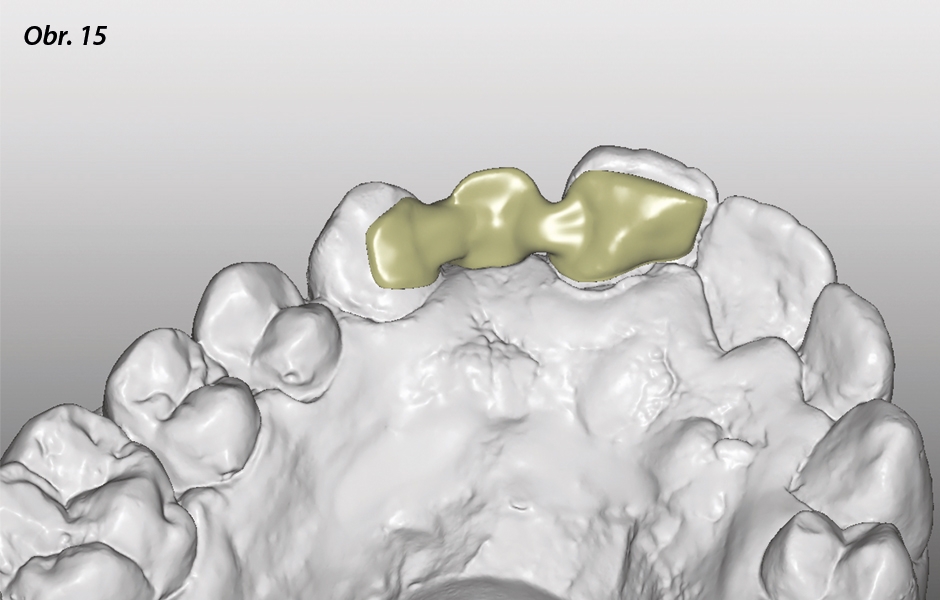 The Zirconia Resin Bonded Bridge (RBB)