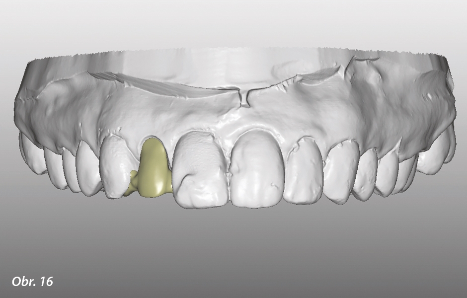 The Zirconia Resin Bonded Bridge (RBB)