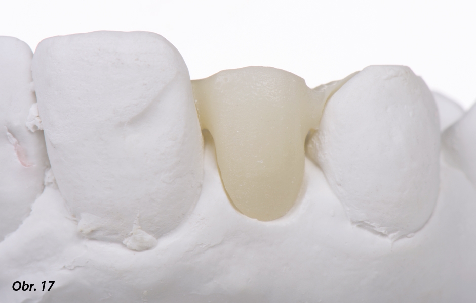 The Zirconia Resin Bonded Bridge (RBB)