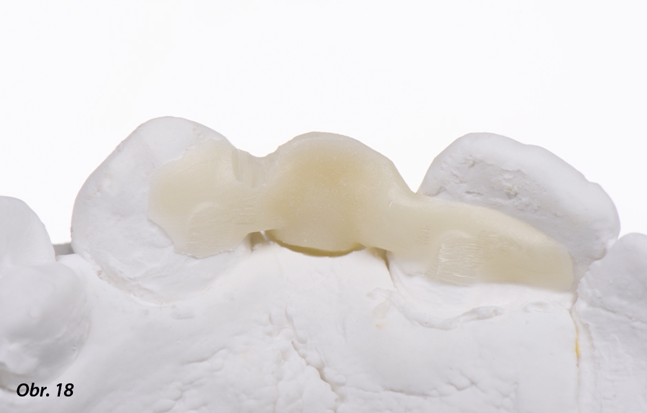 The Zirconia Resin Bonded Bridge (RBB)