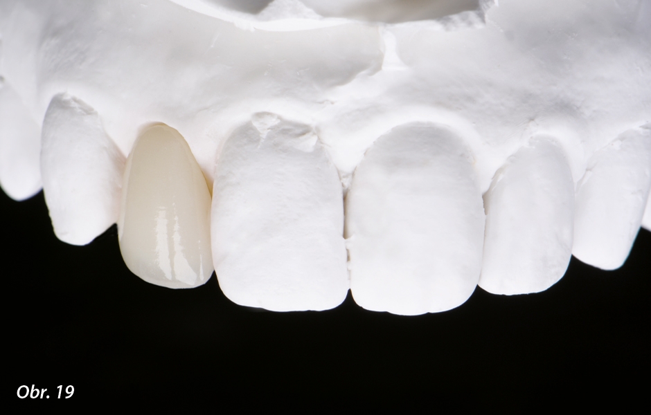 The Zirconia Resin Bonded Bridge (RBB)