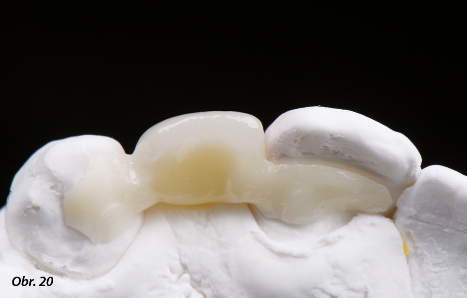 The Zirconia Resin Bonded Bridge (RBB)