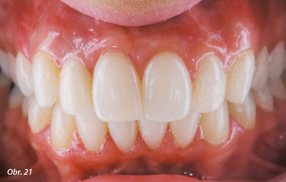 The Zirconia Resin Bonded Bridge (RBB)