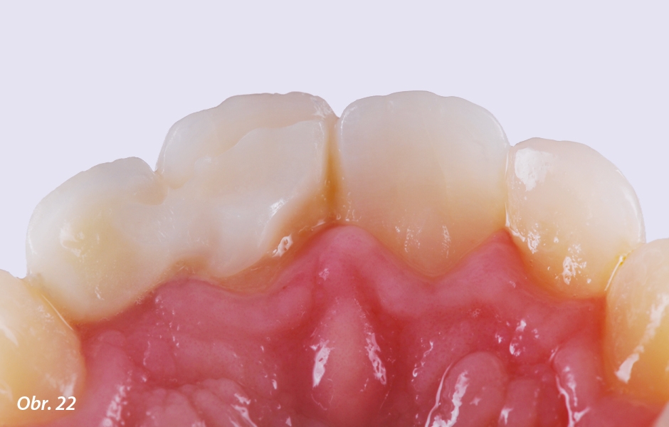 The Zirconia Resin Bonded Bridge (RBB)