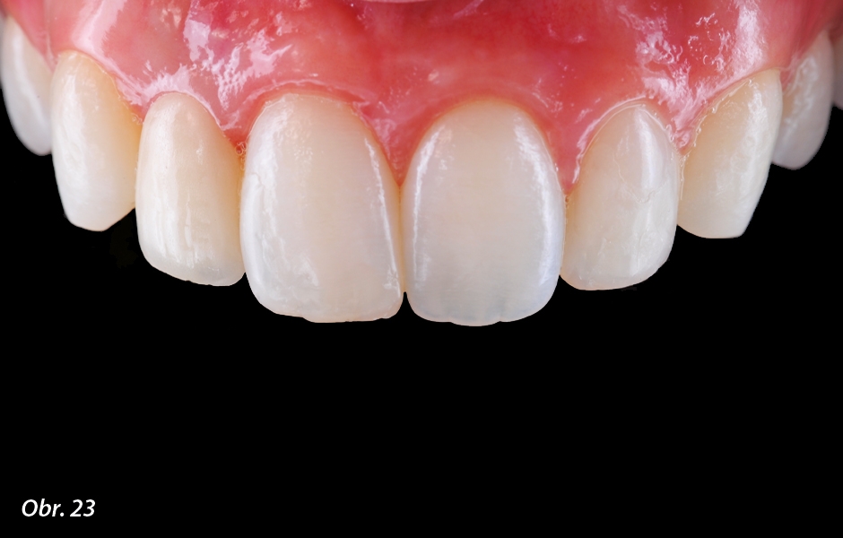 The Zirconia Resin Bonded Bridge (RBB)