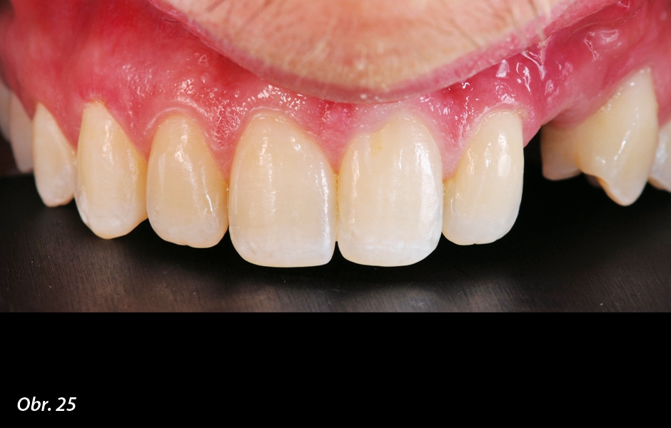 The Zirconia Resin Bonded Bridge (RBB)