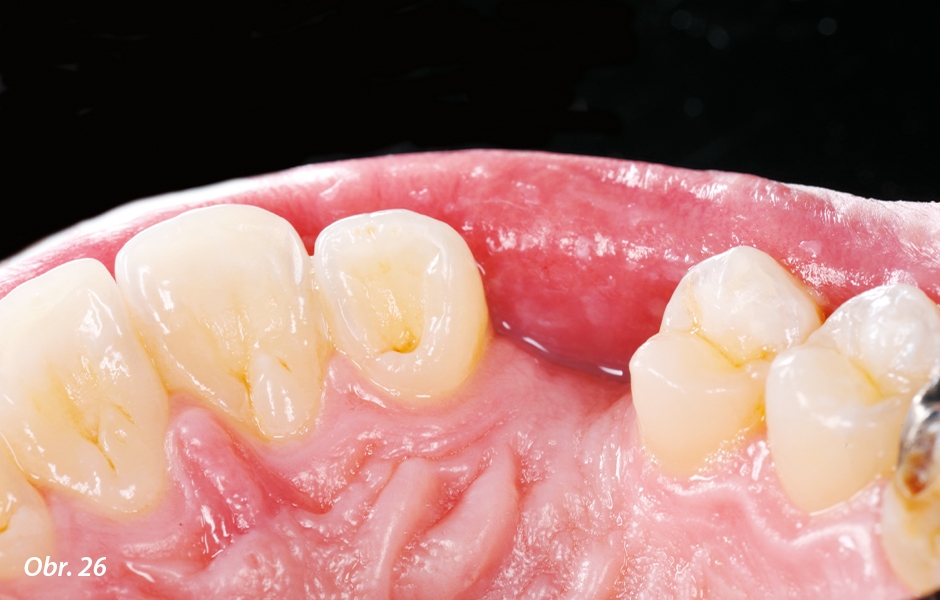 The Zirconia Resin Bonded Bridge (RBB)