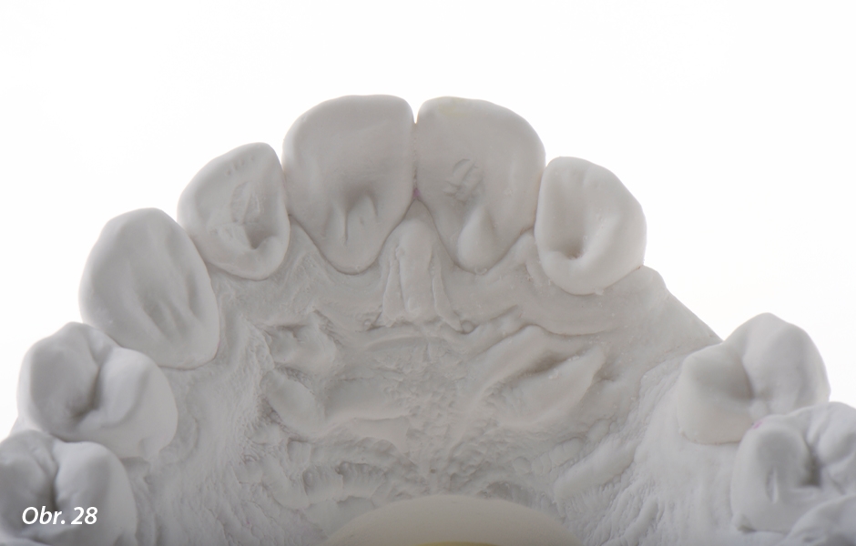 The Zirconia Resin Bonded Bridge (RBB)