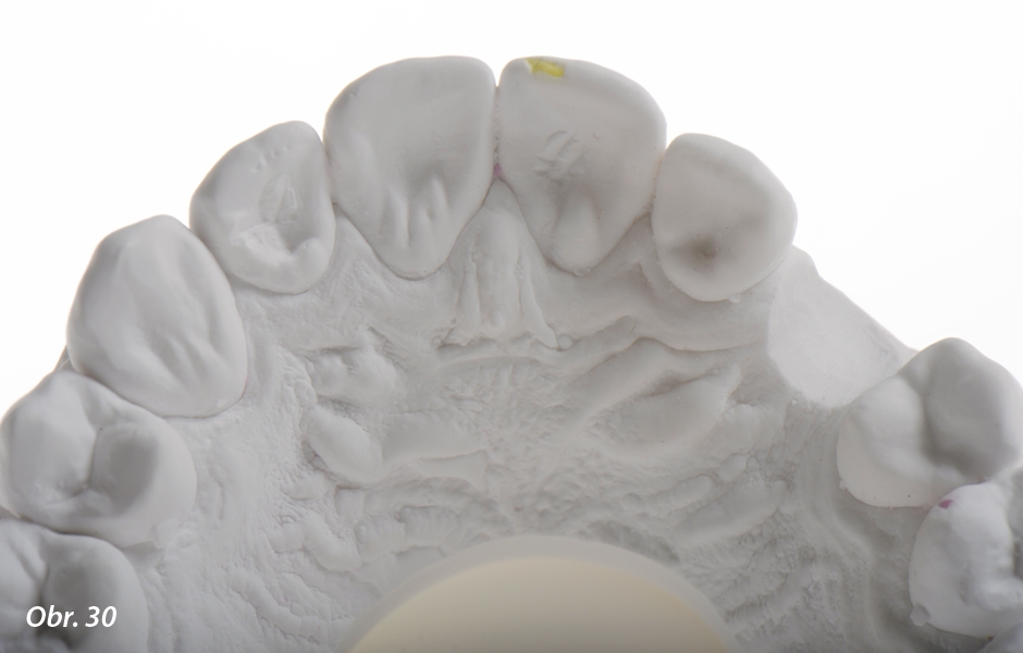 The Zirconia Resin Bonded Bridge (RBB)