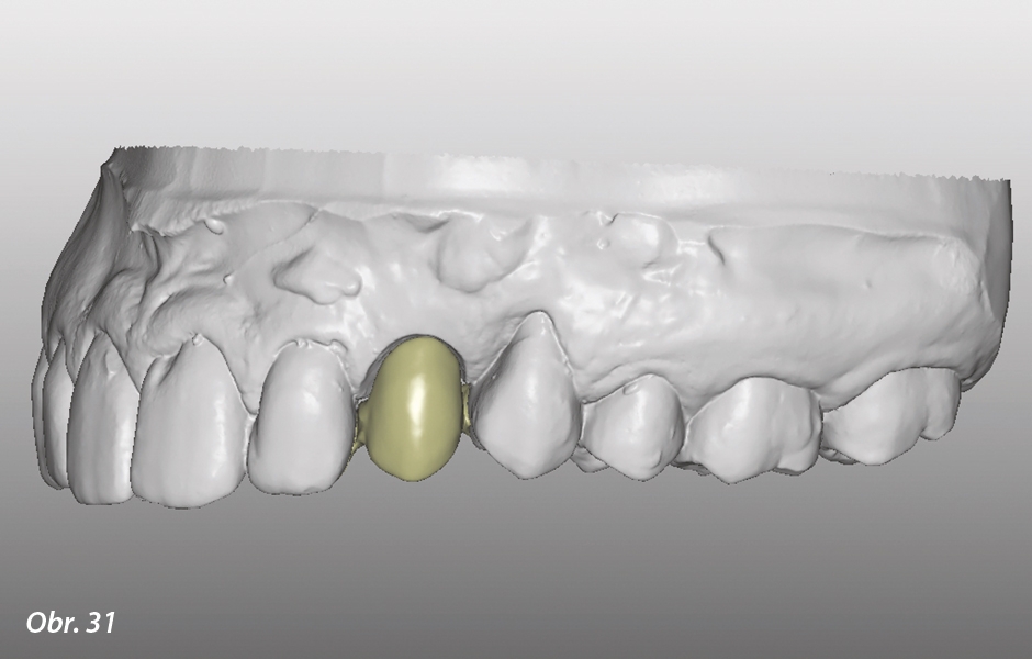 The Zirconia Resin Bonded Bridge (RBB)