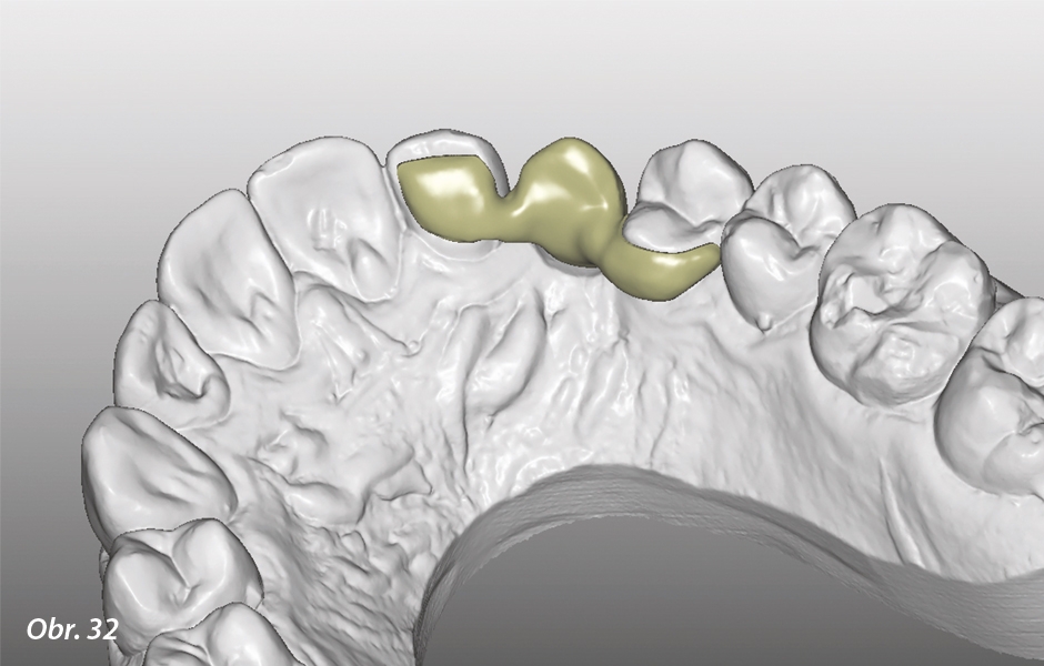 The Zirconia Resin Bonded Bridge (RBB)