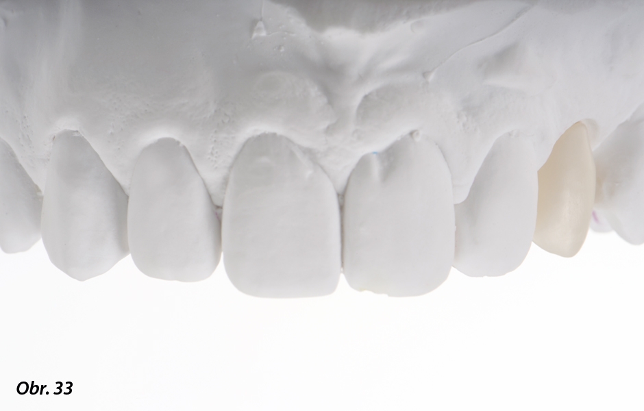 The Zirconia Resin Bonded Bridge (RBB)