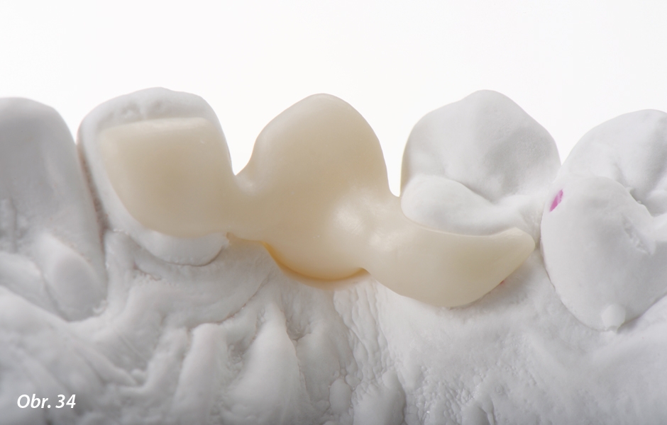 The Zirconia Resin Bonded Bridge (RBB)