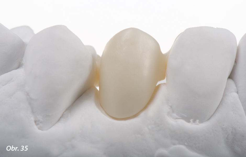 The Zirconia Resin Bonded Bridge (RBB)