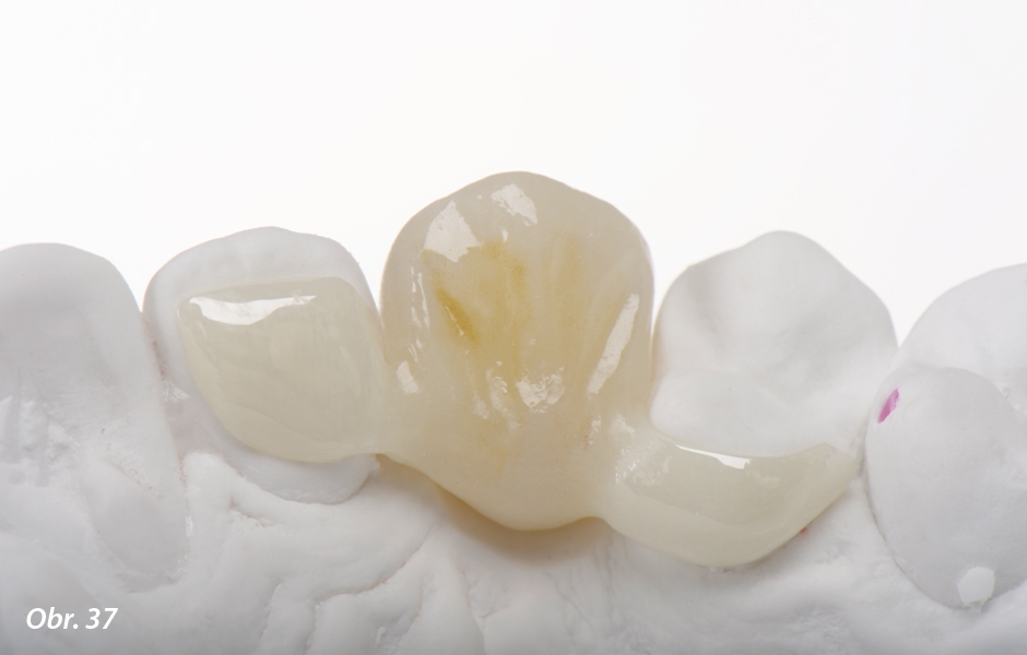 The Zirconia Resin Bonded Bridge (RBB)