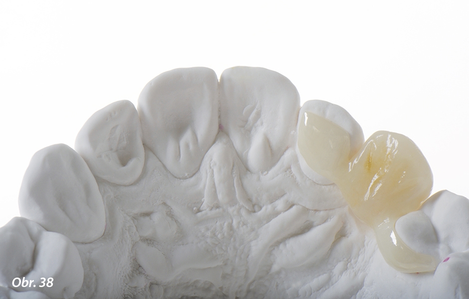 The Zirconia Resin Bonded Bridge (RBB)