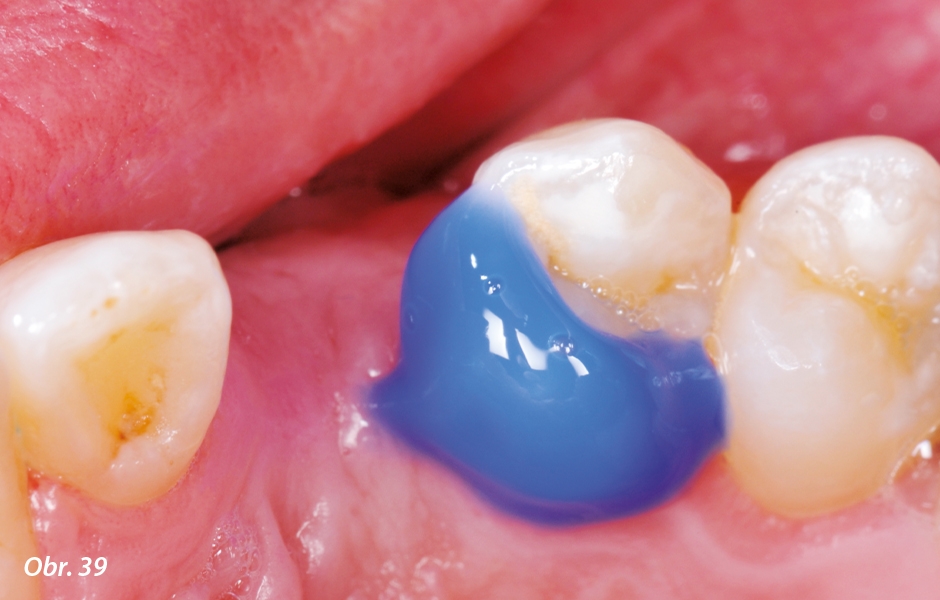 The Zirconia Resin Bonded Bridge (RBB)