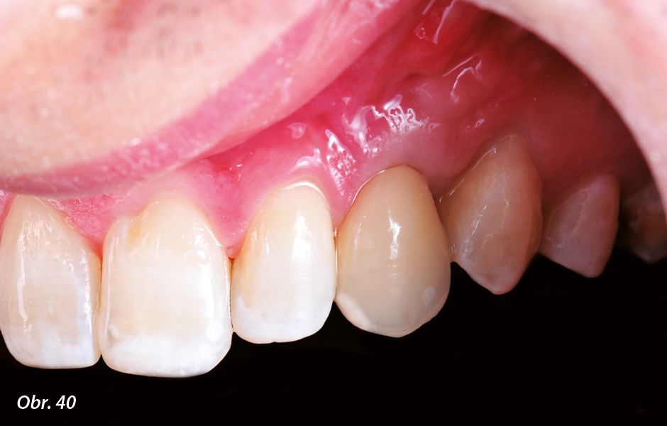 The Zirconia Resin Bonded Bridge (RBB)