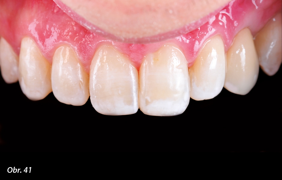 The Zirconia Resin Bonded Bridge (RBB)