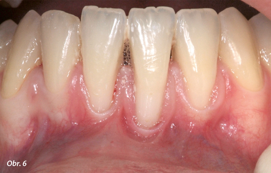 Situace před ošetřením. Všimněte si extrémně tenkého biotypu parodontu stejně jako minimálního množství keratinizované tkáně.