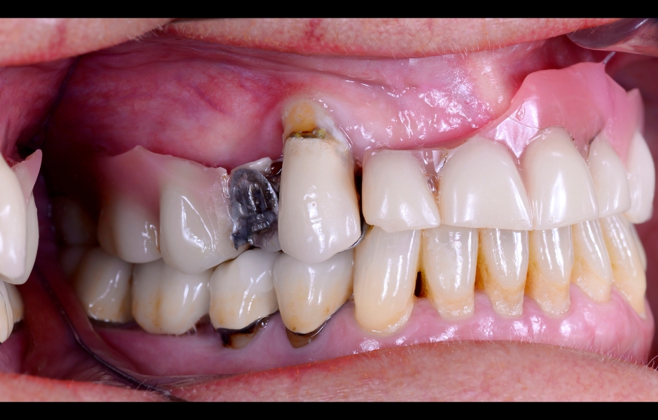 Obr. 1: Klinická a radiologická výchozí situace v horní čelisti se selhávajícími předchozími rekonstrukcemi.