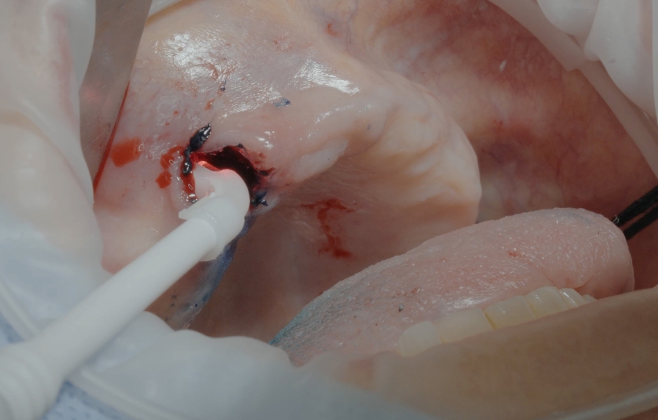 Obr. 10: Aplikace a aktivace Helbo (bredent medical).