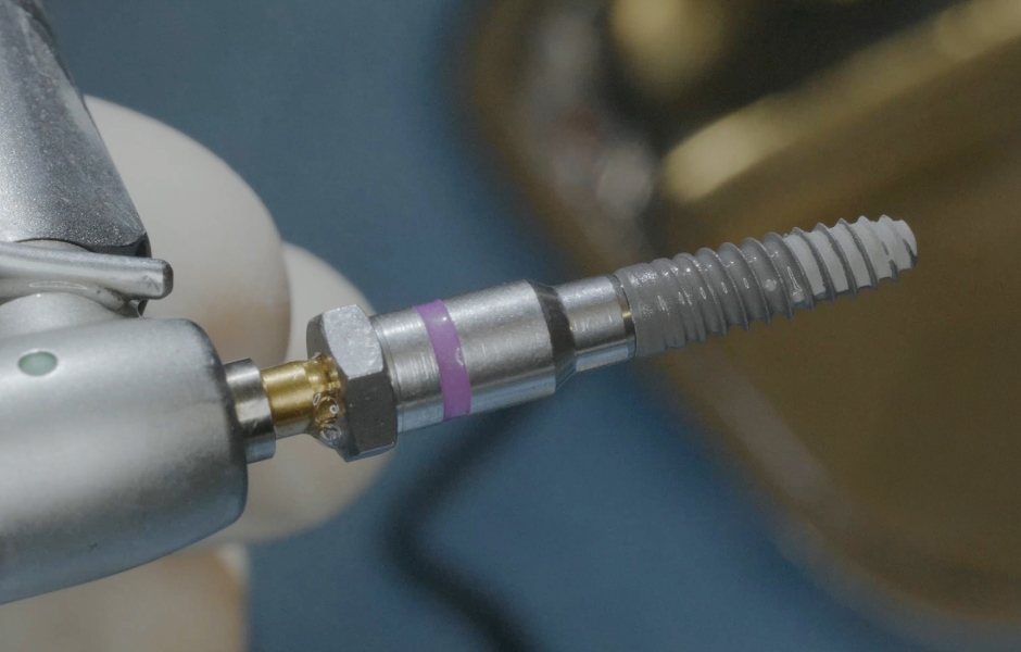 Obr. 12: Implantát copaSKY (bredent medical) navlhčený PRF na zaváděcím trnu.