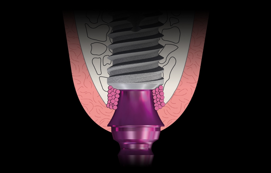 Obr. 13: Subkrestální nosná plocha na abutmentu SKY uni.cone (bredent medical).
