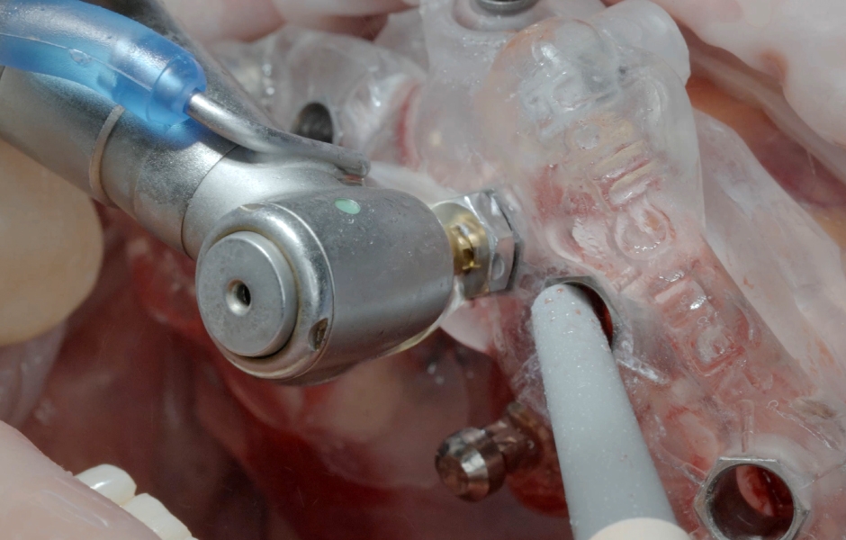 Obr. 15: Primárně stabilní definitivní pozice implantátu copaSKY