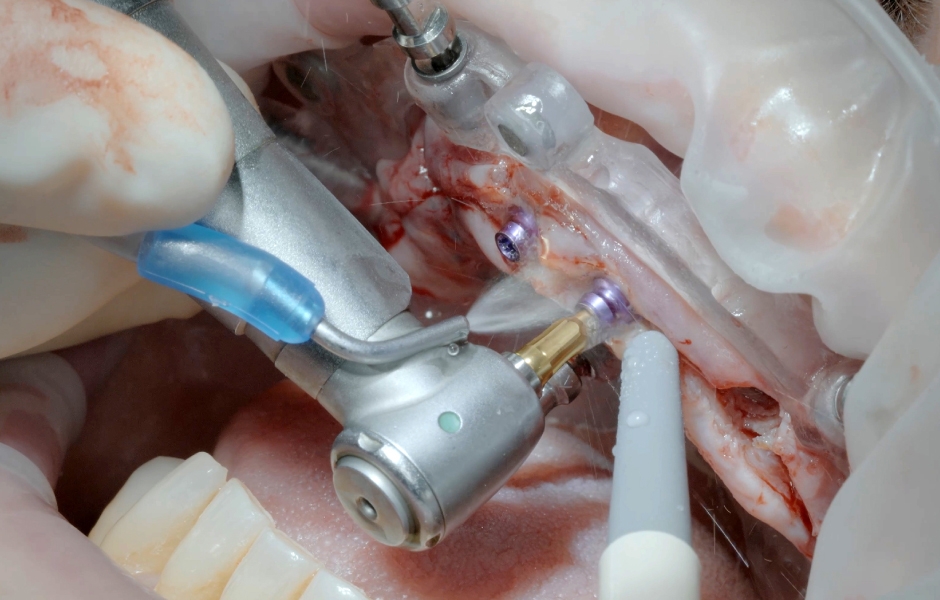 Obr. 17: Zavedení abutmentů uni.cone, zde v oblasti 11, s využitím dělené chirurgické šablony.