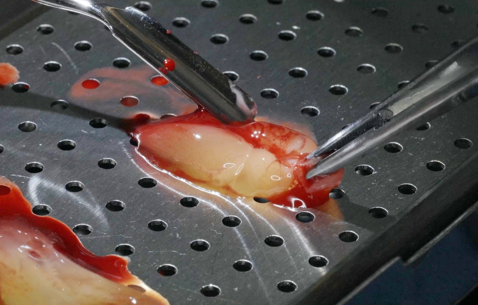 Obr. 19: Kompaktní L-PRF získané centrifugací z venózní krve pacientky.