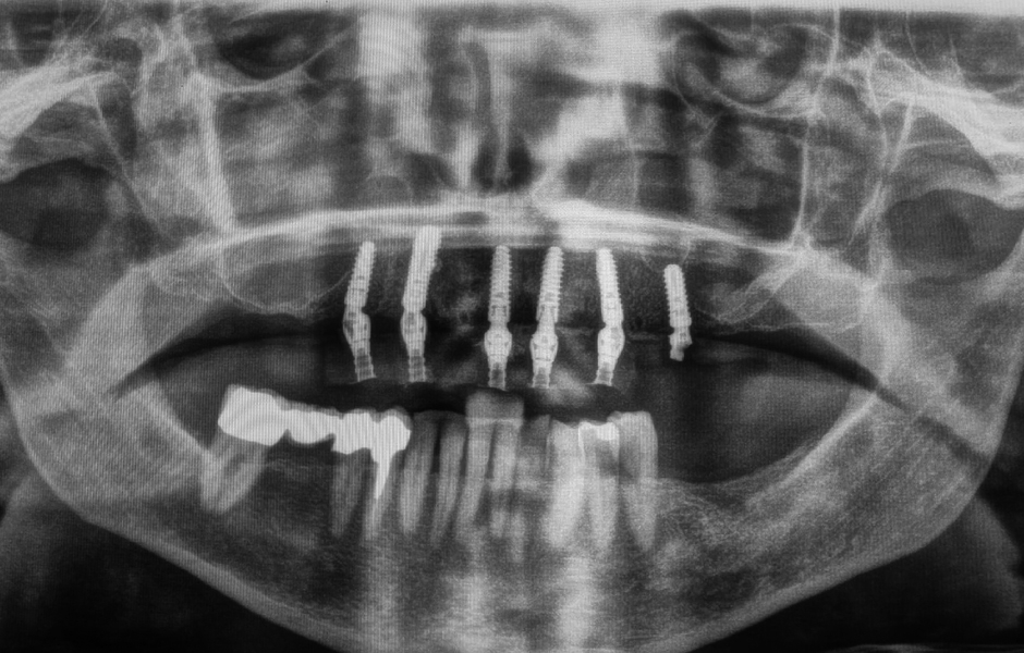 Obr. 21: Rentgenový kontrolní snímek s protetickými kapnami.