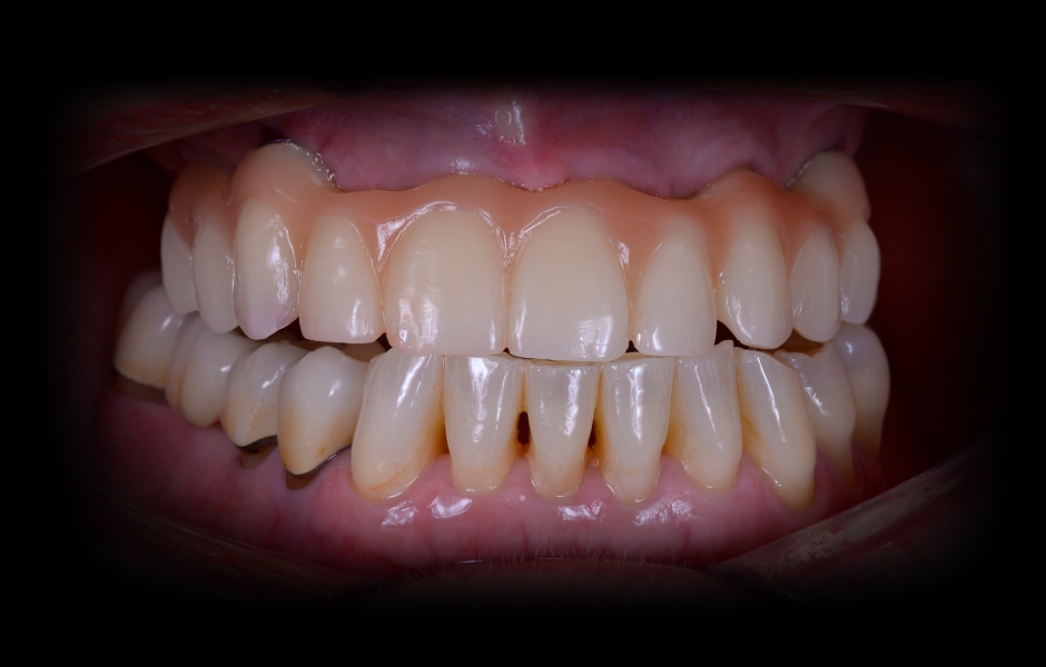 Obr. 22: Dokončená okamžitá provizorní náhrada in situ.