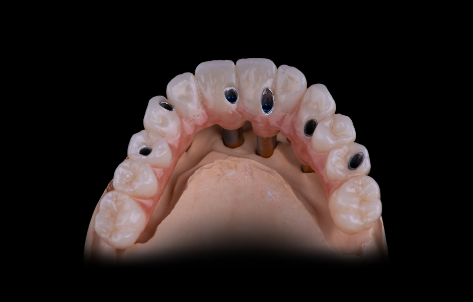 Obr. 26: Okluzální pohled na definitivní rekonstrukci s palatinálními šroubovými kanálky.