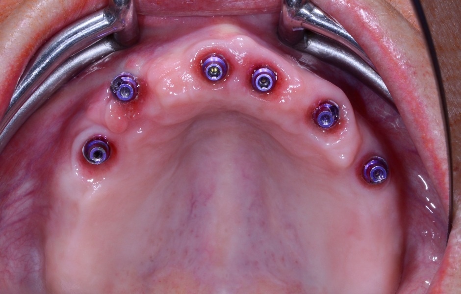 Obr. 27: Situace v horní čelisti po sejmutí provizoria.