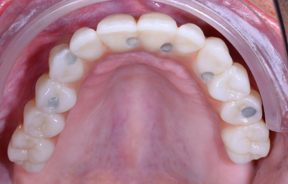 Obr. 28: Nasazená definitivní rekonstrukce.