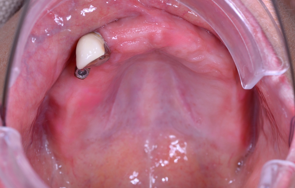 Obr. 3: Klinická a radiologická výchozí situace v horní čelisti se selhávajícími předchozími rekonstrukcemi.