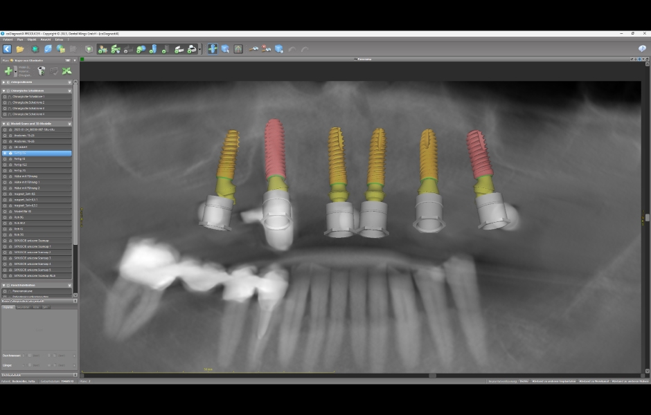 Obr. 5: Plánované implantáty z hlediska velikosti, délky a orientace.