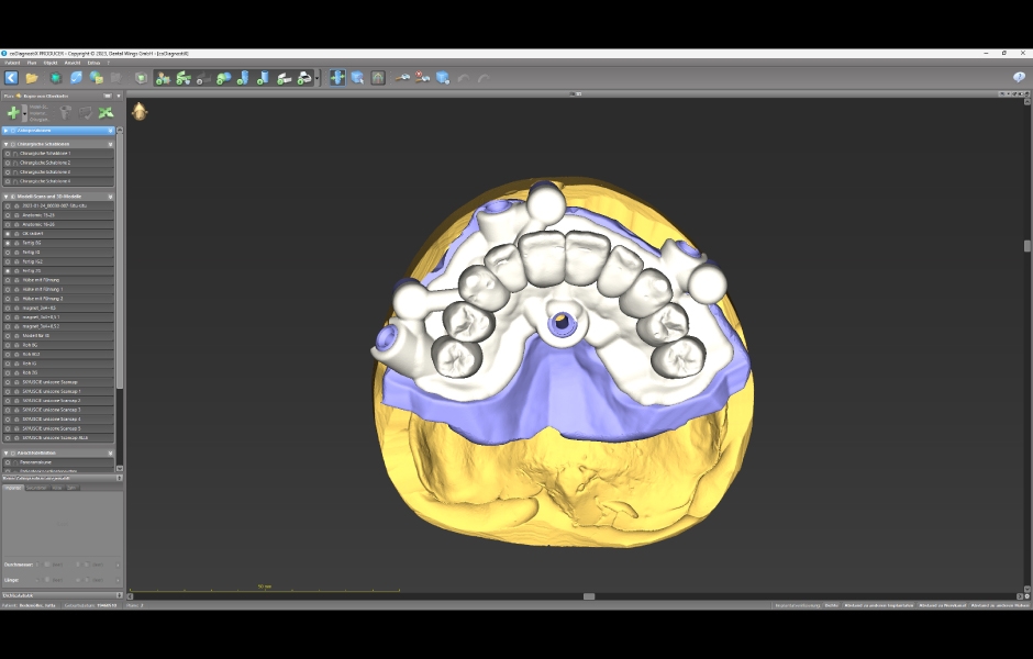 Obr. 7: Návrh a výroba modulární chirurgické šablony s okluzálně-palatinálními vstupy pro šrouby.