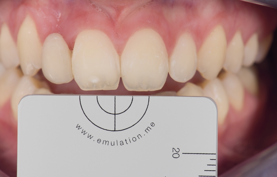 Pro ověření barvy zvolené pro umělý zub a pro stanovení barvy dentinu byly pořízeny fotografie s polarizačním filtrem, šedou kalibrační kartou a nastaveními fotoaparátu a blesku dle protokolu eLABor_aid.