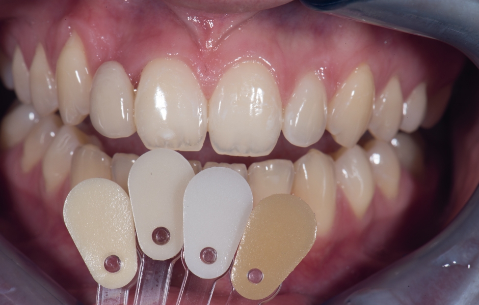 Na základě získané základní barvy přirozených zubů byly dále vybrány a fotograficky zdokumentovány barevné efekty vzorků keramických hmot určených pro estetické fazetování.