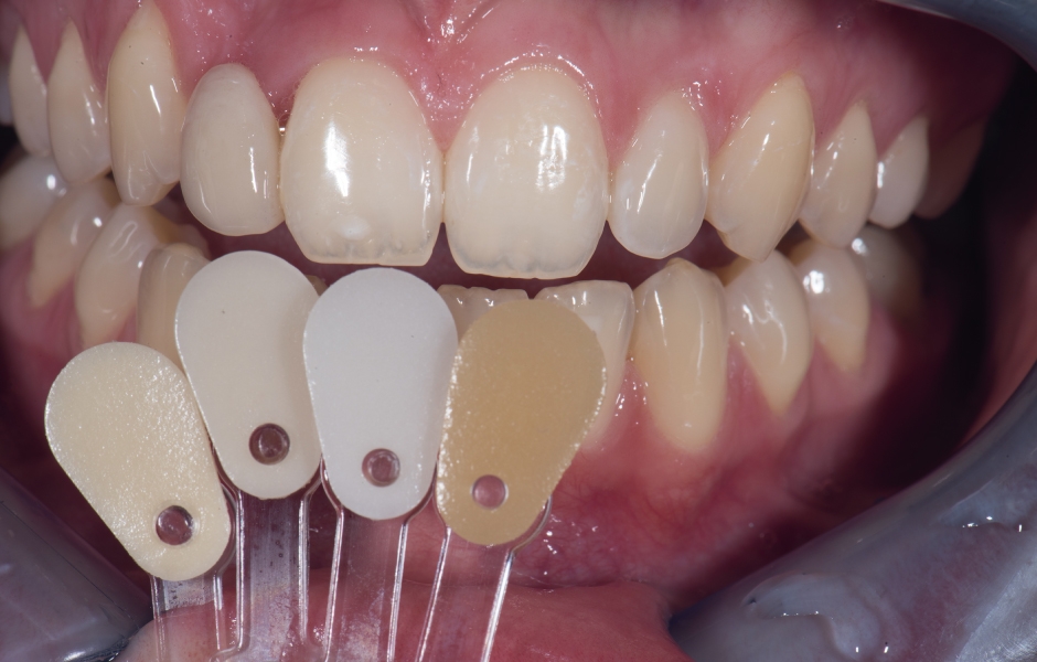 Na základě získané základní barvy přirozených zubů byly dále vybrány a fotograficky zdokumentovány barevné efekty vzorků keramických hmot určených pro estetické fazetování.