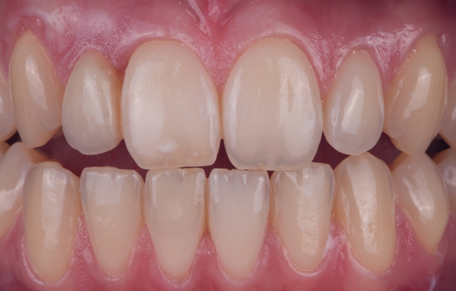 Chybějící zub pacienta tedy bylo možno velmi dobře nahradit adhezivním můstkem s jedním křidélkem bez nutnosti uchýlit se k výrobě korunky kotvené implantátem.