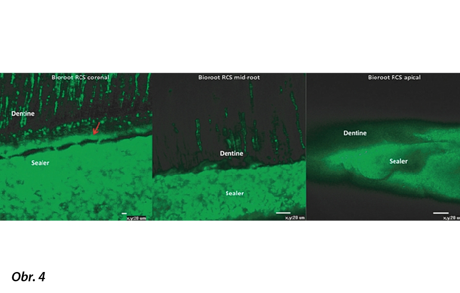Konfokální mikroskopické snímky rozhraní BioRoot ™ RCS s dentinem na různých úrovních v délce kořenového kanálku zachycují zónu infiltrace minerály a zakončení pečetidla v dentinových kanálcích (přetištěno se svolením Viapiana a kol. 2016).